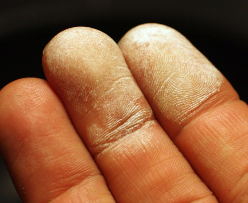 Hydrogen peroxide 35 percent on skin.jpg