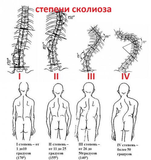 Stepeni-skolioza1-1.jpg